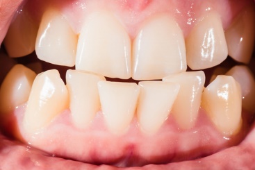 Malocclusion – Dental Problem