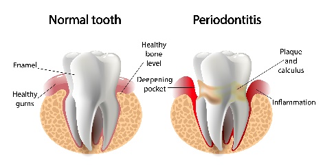 Periodontitis – Dental Problem