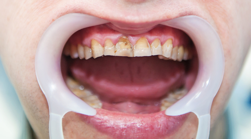 Fluorosis – Dental Problem