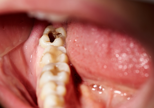 Cavities Dental Treatment